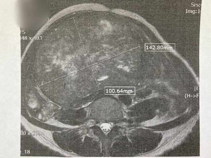 巨大子宮筋腫で尿管が圧迫されて腎臓が腫れて水腎症になったMIR検査画像