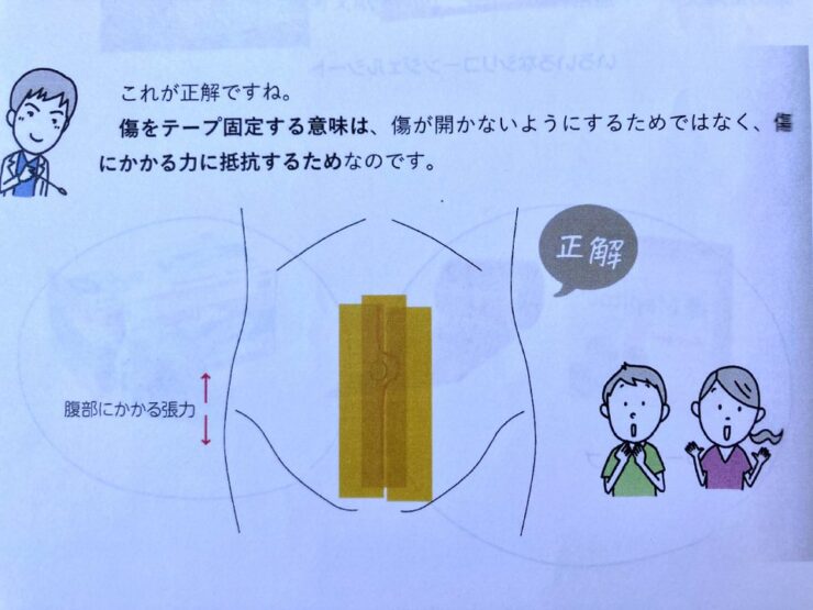 子宮筋腫核出術の開腹手術後にケロイド防止のためお腹の傷跡に貼るテープは縦方向